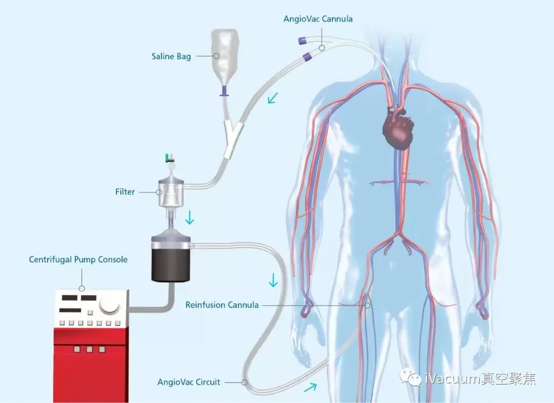 医学应用 | 真空技术有望用于清除心脏中的致命血块